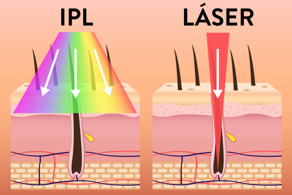 ipl_and_laser